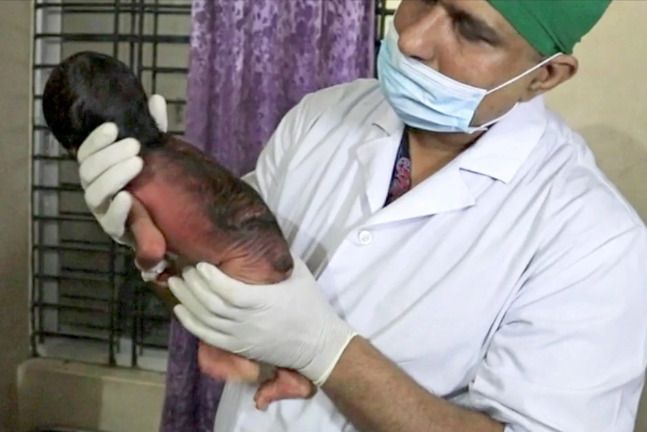 Dete je rođeno sa dosta dlaka na telu