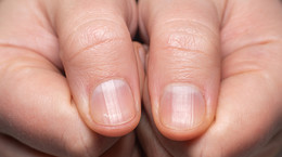 Wysoki poziom cholesterolu widać na paznokciach. Dwa subtelne i wymowne sygnały