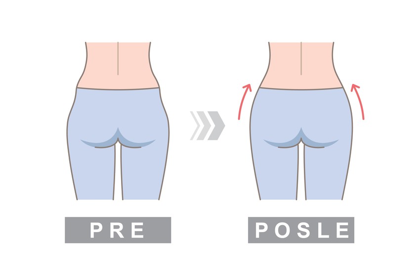 Udubljenja na kukovima ne mogu trajno da se eliminišu, osim ako se ne podvrgnete operaciji
