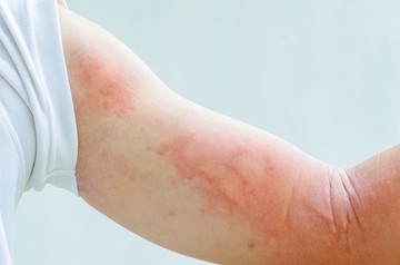 csalánkiütés bőrbetegségek allergia diéta autoimmun betegség bőrbetegség