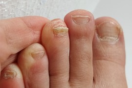 Ruski dermatolog tvrdi da GLJIVICE NA NOKTIMA NESTAJU ZAUVEK ako ih potopite dva puta dnevno u OVU DOMAĆU KUPKU od 2 sastojka!