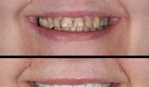 Promena boje zuba može da se koriguje i u stomatološkoj ordinaciji i kod kuće u zavisnosti od uzroka