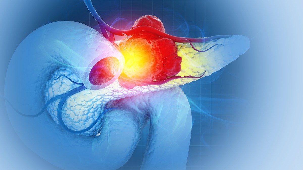 Simptomi raka pankreasa u ranoj fazi često izostaju 
