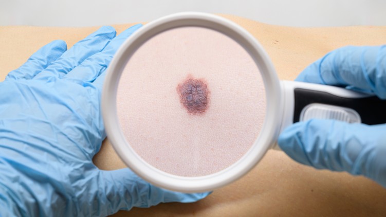 Melanoma, bőrrák, tünet