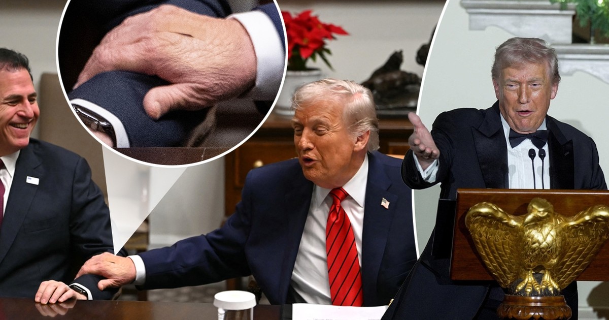 Dłoń Trumpa oklejona plastrami. Biały Dom przyznaje, co naprawdę się dzieje