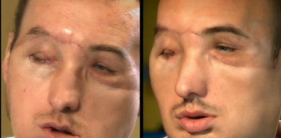 Pacjent po przeszczepie twarzy: Dostałem drugie życie!