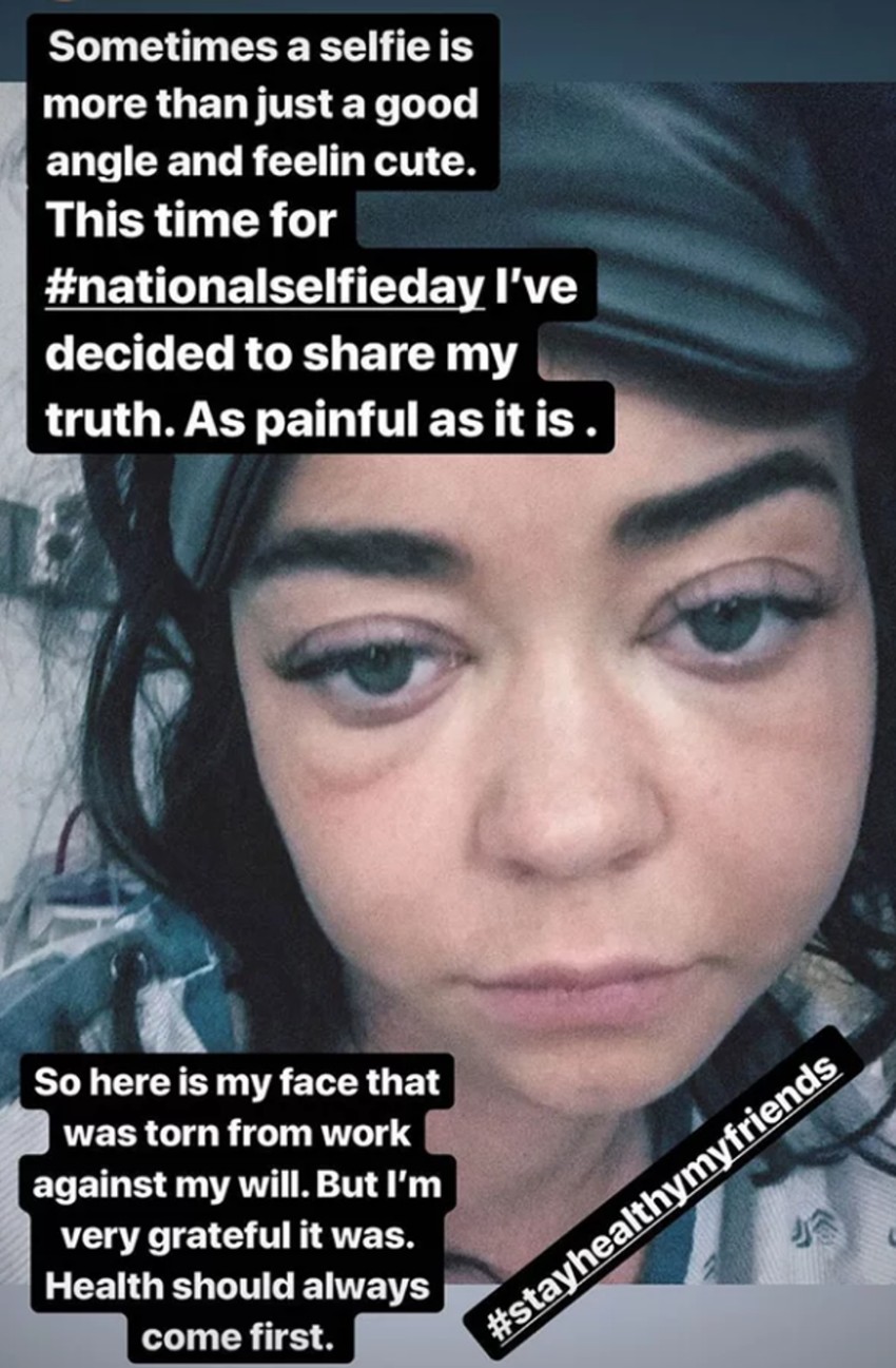 Sara Hiland, otečena i neprepoznatljiva