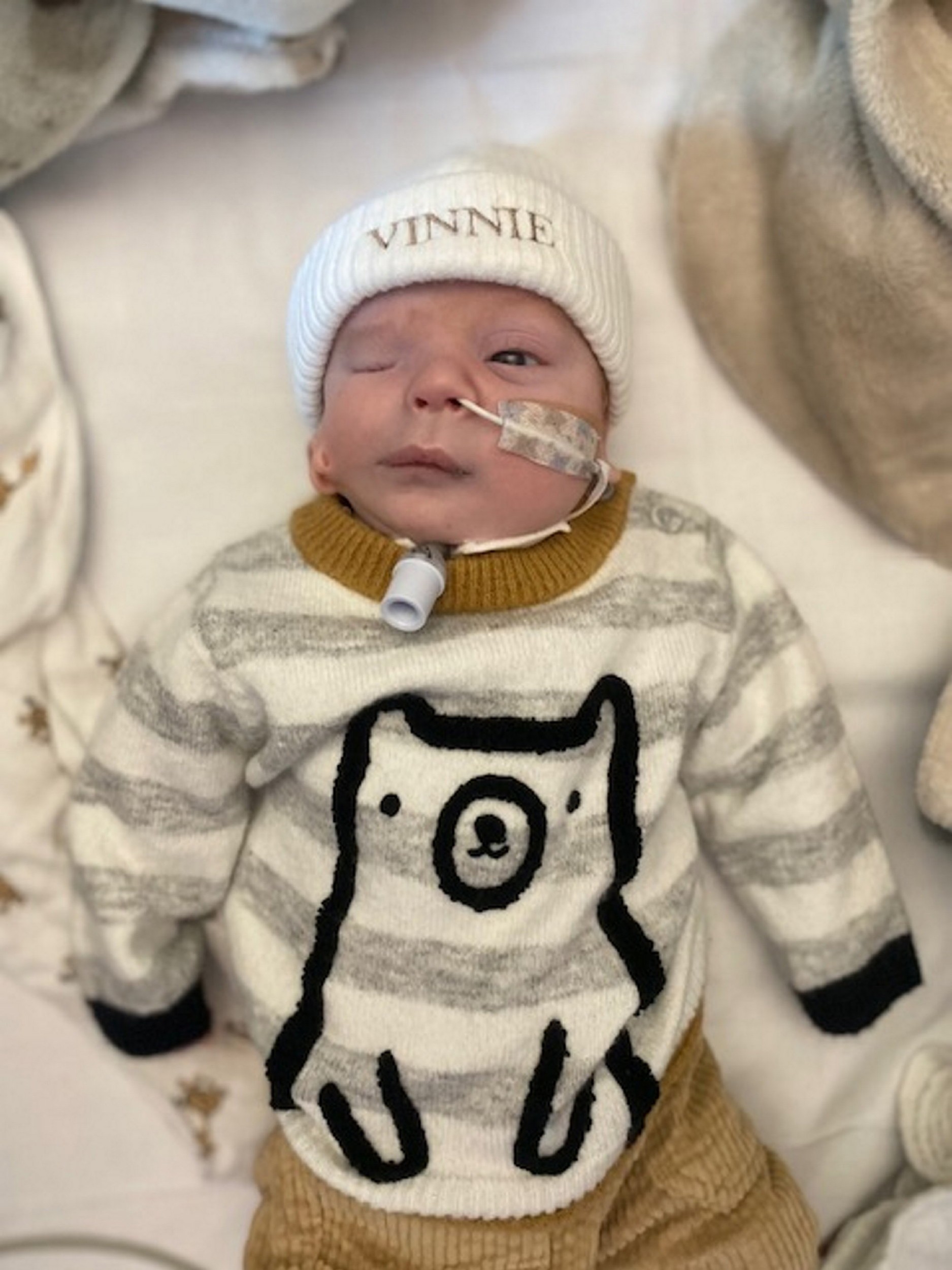 Malý Vinnie sa narodil so zriedkavým syndrómom.