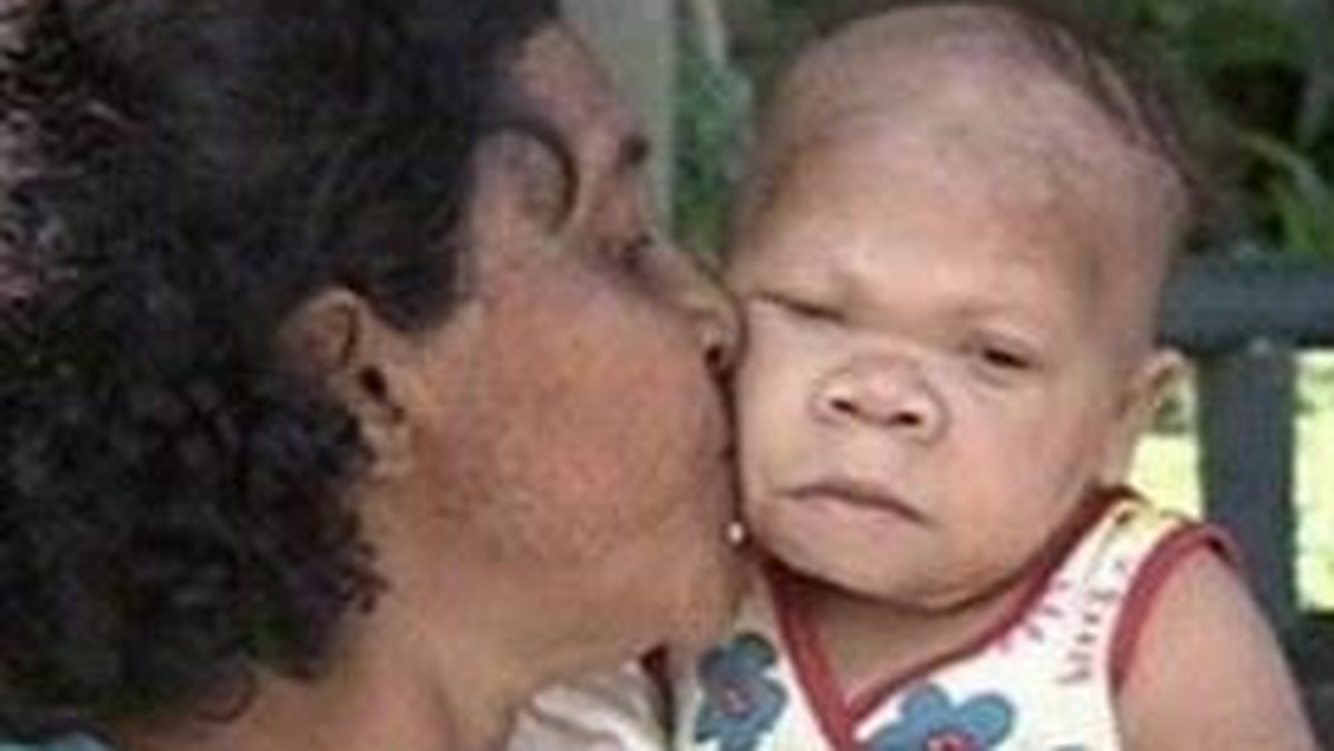 Maria Audete do Nascimento ma 35 lat i pochodzi z Brazylii. Mimo swojego wieku wygląda jak noworodek. Kobieta urodziła się z niedoczynnością tarczycy i zaburzeniami hormonalnymi, które sprawiły, że nie rozwijała się odpowiednio pod kątem fizycznym i psychicznym.
