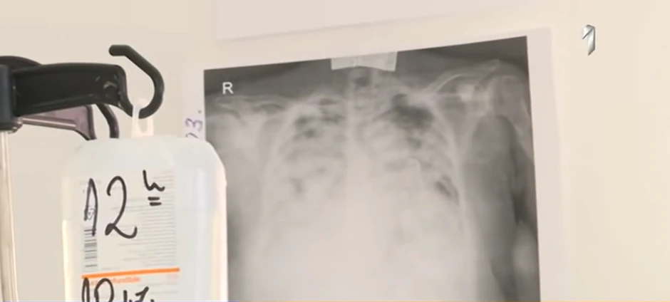 Slimak pluća koja je razorio korona virus 