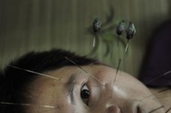 A patient suffering from facial paralysis undergoes acupuncture treatment at a traditional Chinese m