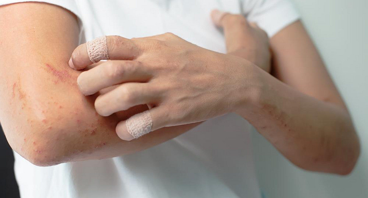 Egzema na dłoniach - przyczyny, objawy, leczenie. Jak zaczyna się choroba?