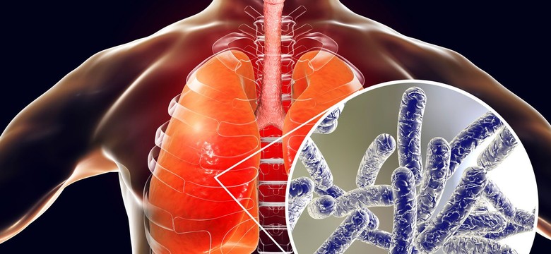 Legionella w kolejnym województwie