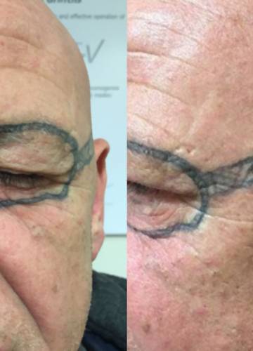 Összehasonlítás hatékonyság öblítés felébredt szemüveget tetováltatott  magának Idősebb Újra Ciro