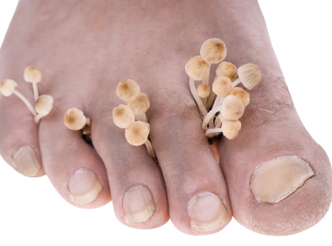 Grzybica atakuje najpierw stopy, potem paznokcie?