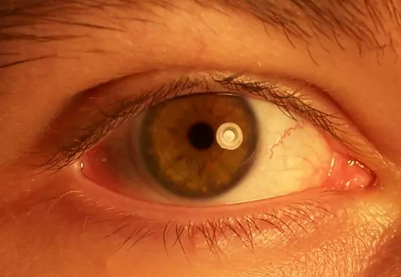 Mężczyzna stracił oko przez złe używanie soczewek kontaktowych. Teraz ostrzega innych