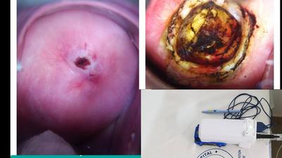 The portable Cure/Liger Medical Electrosurgical Unit. Cervix before and after treatment by LEEP