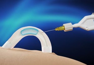 Procedura ugradnje traje 10 minuta i radi se u lokalnoj anesteziji 