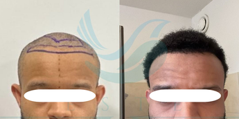 Top 5 best afro hair transplant clinics in Turkey: Complete guide to  specialized hair restoration | Business Insider Africa