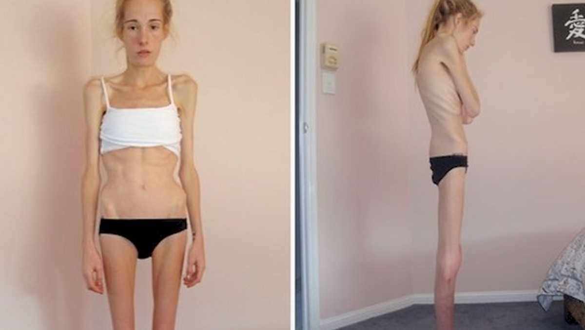 Gemma Walker, cierpiąca na anoreksję i bulimię, w wieku 14 lat ważyła niecałe 29 kilogramów. Lekarze twierdzili, że ma niewielkie szanse żyć dłużej niż 48 godzin. Dzięki terapii udało jej się wyjść z choroby.