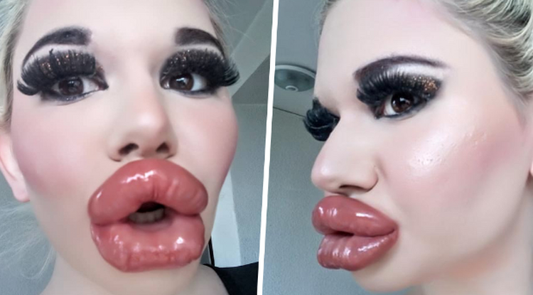 Élete árán sem áll le a plasztikával: a világ legnagyobb ajkaira hajt a 22 éves nő – Fotók