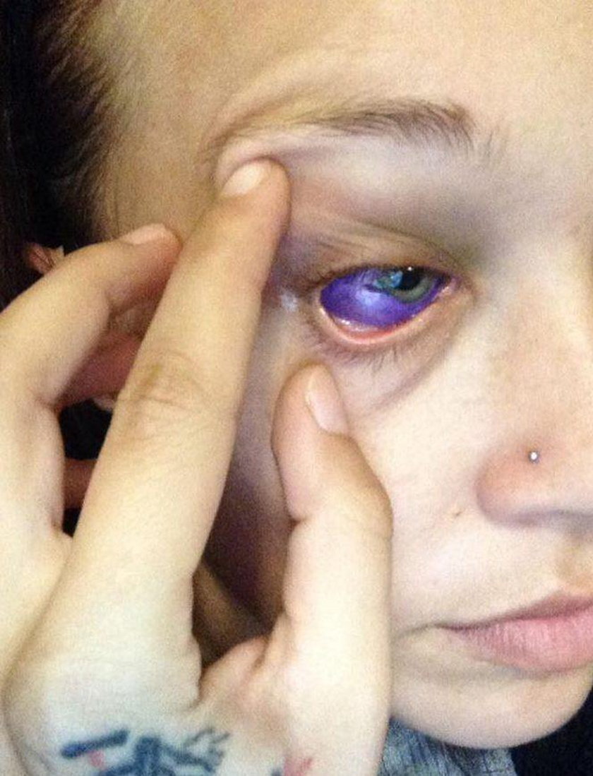 Tatuażysta zepsuł kobiecie oko