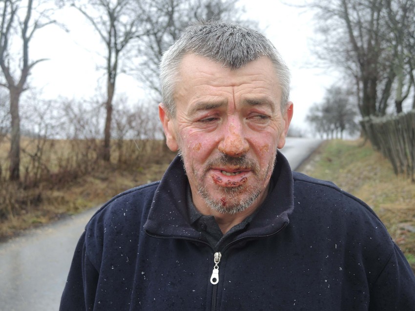 Zbog opekotina na licu i rukama 10 dana je ležao u užičkoj bolnici