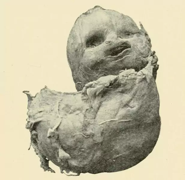 Litopedion, &quot;kamienny płód&quot; Ilustracja z książki &quot;A textbook of obstetrics&quot; W. B. Saunders, 1898