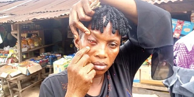 Woman accuse husband of blinding her eye after marrying second wife