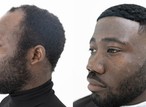 5 lifestyle habits and remedies for men's receding hairline
