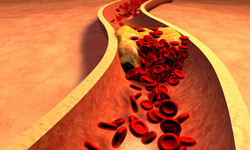 Jesteś młody i szczupły i masz wysoki cholesterol? To może być ta &quot;niewidzialna choroba&quot;