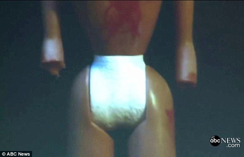 ... i odsečenih udova