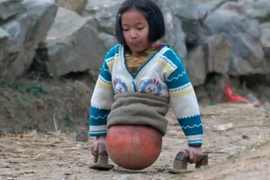 Nakon AMPUTACIJE NOGU hodala je na KOŠARKAŠKOJ LOPTI! Roditelji nisu imali para za proteze, a onda se sve PROMENILO - planeta je plakala od sreće zbog onoga što je postala