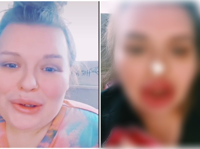 Alergijska reakcija na filere u usnama