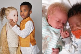 Kada je posle porođaja videla svoje BLIZANCE, mislila je da su joj ZAMENILI BEBE - jedna je bila CRNA, druga POTPUNO BELA! "Čekali smo ih 8 godina, a onda je otkrivena šokantna istina"