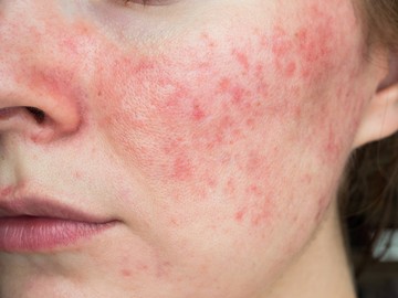 rosacea, tünetei, kezelése
