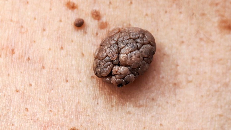 melanoma bőrrák tünet anyajegy elváltozás