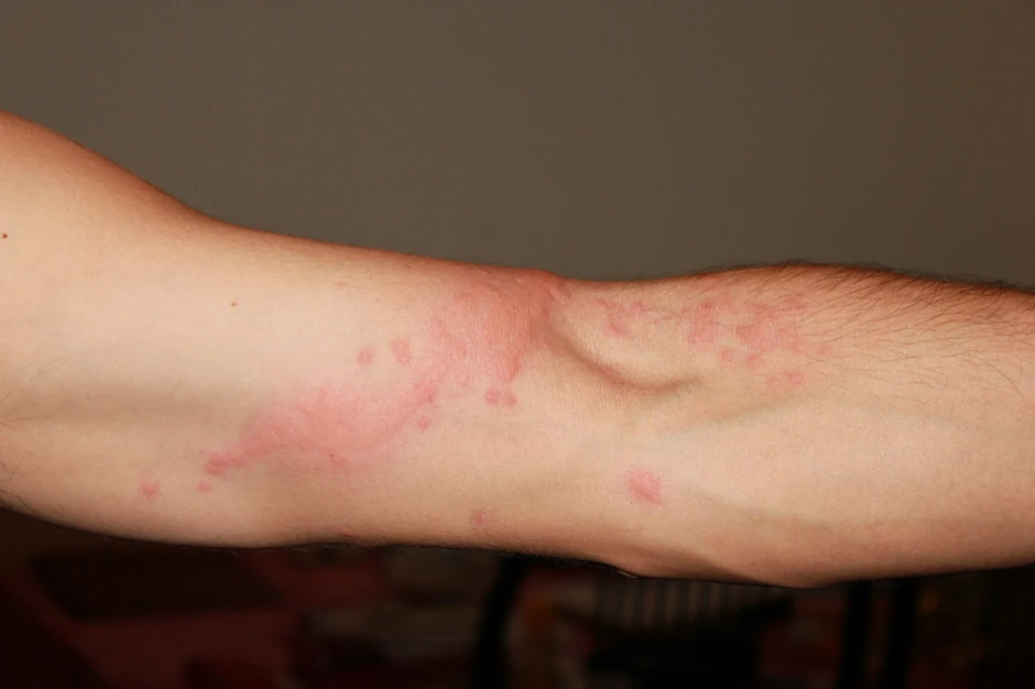 Karakterističan izgled osipa na koži usled ujeda meduze