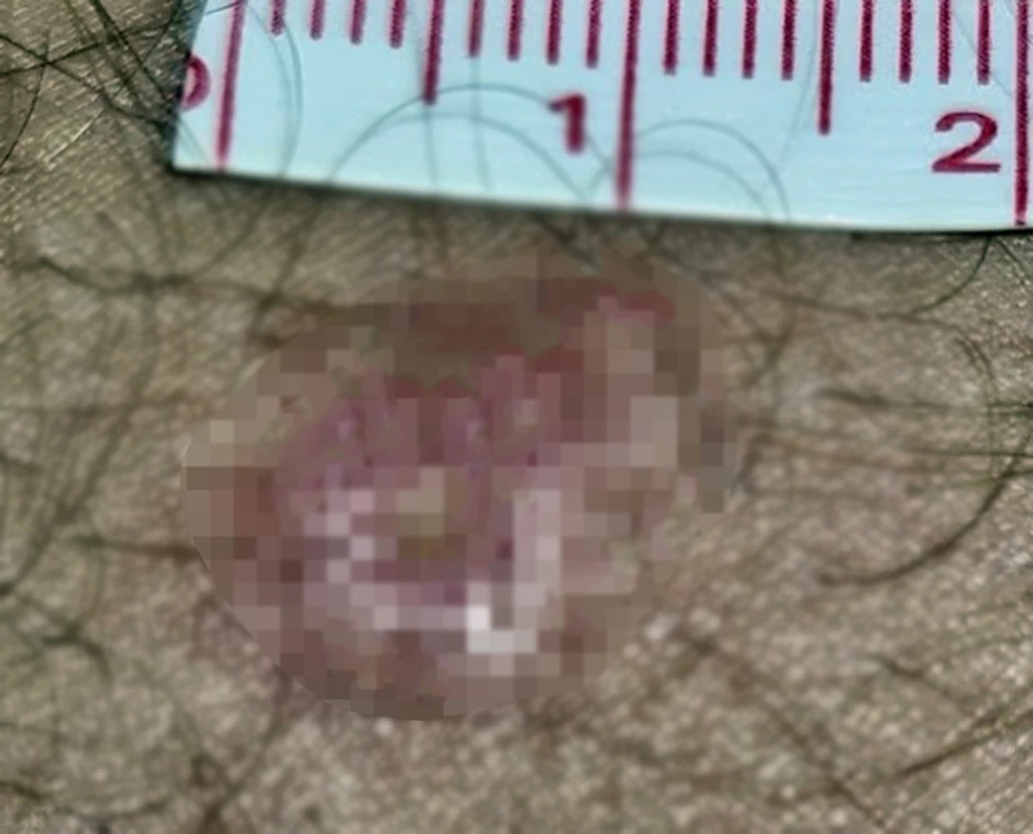 Ujedi su bolni i svrbe