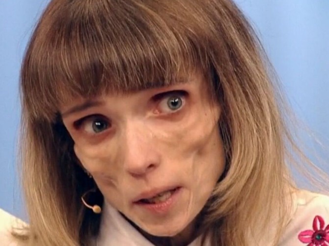 Kristina je u jednom momentu imala samo 17 kg, a ovako izgleda njena borba sa anoreksijom