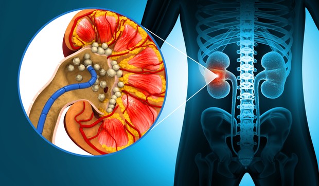 Kamen u bubregu može da izazove zatvor i druge gastrointestinalne probleme