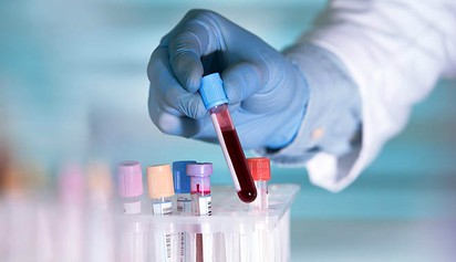 IR, PCOS, cukorbetegség: itt az új és egyszerűbb vizsgálat
