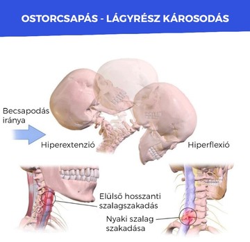 Autóbalesetek után sokan küzdenek nyakfájdalommal