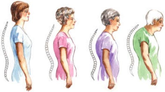 tompa fájdalom a lapockák között a gerincben hogyan lehet enyhíteni a fájdalmat a gerincben osteochondrosissal