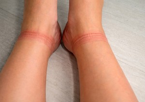 Tragovi od čarapa na nogama – kad su udubljenja normalna, a kada ukazuju na bolest?