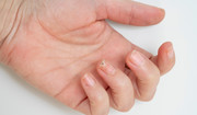 Grzybica paznokcia u rąk - jak sobie radzić i jak zapobiegać?