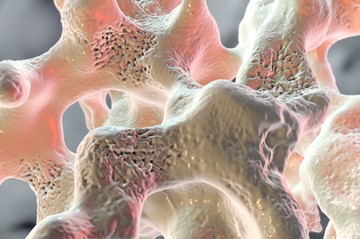 mi az osteoporosis csontritkulás ok tünet kezelés