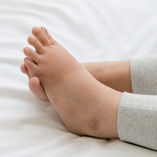 Ödémás, felpüffedt láb: ilyen, amikor vitaminhiány áll a háttérben