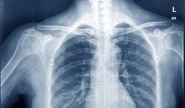 Pušenje je glavni utok bolesti pluća 