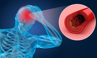 Stroke vagy TIA - ismerje meg a különbségeket a kettő között